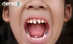 Usta dziecka z widocznymi ubytkami w zębach. Czy próchnica boli? Wizyta u dentysty może zapobiec cierpieniu.