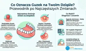 Ilustracja przedstawia ropień na dziąśle, który jest bolesnym zgrubieniem wypełnionym ropą, często spowodowanym infekcją zęba.