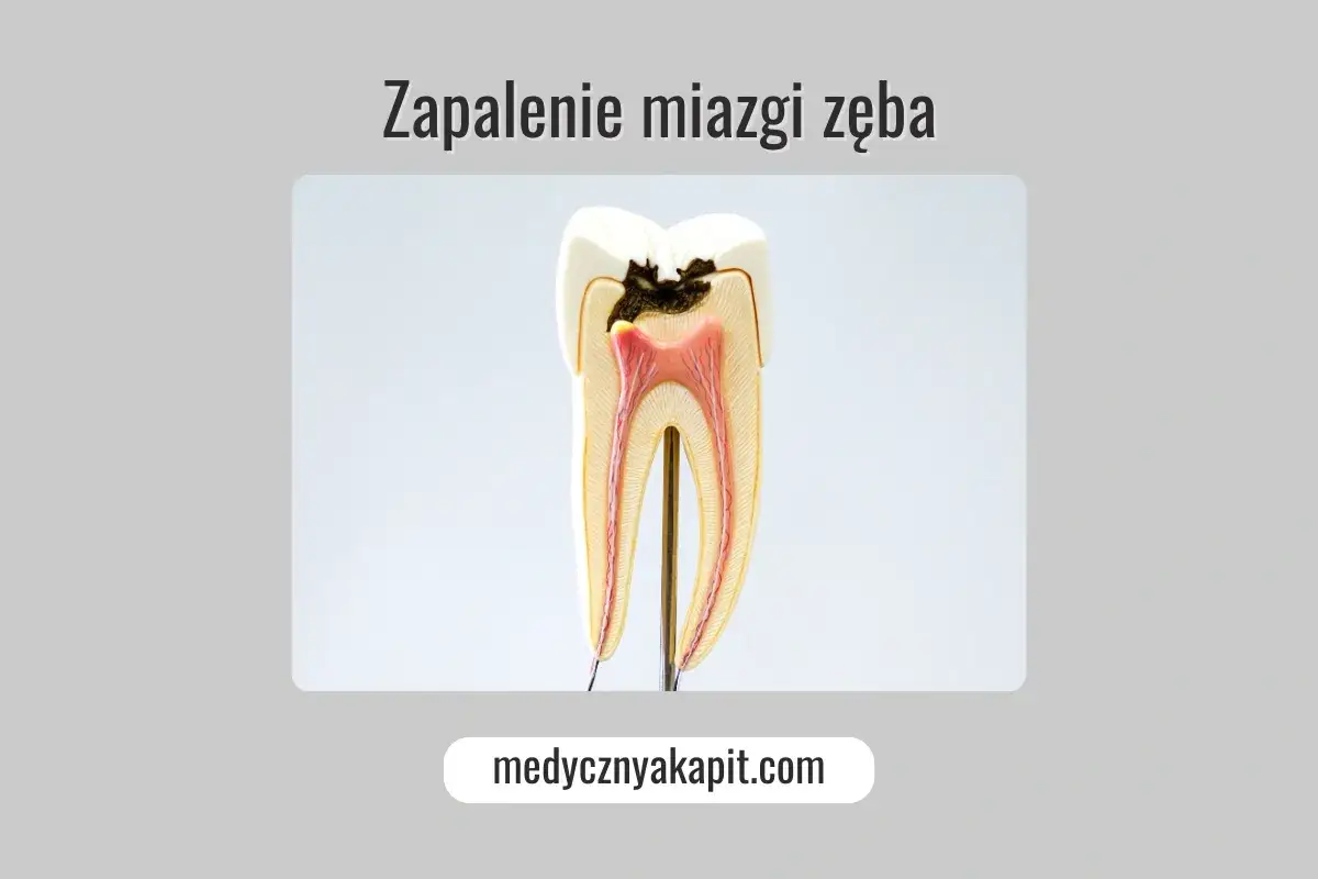 Model zęba z próchnicą i zapaleniem miazgi, symbolizujący tragiczny ból zęba.