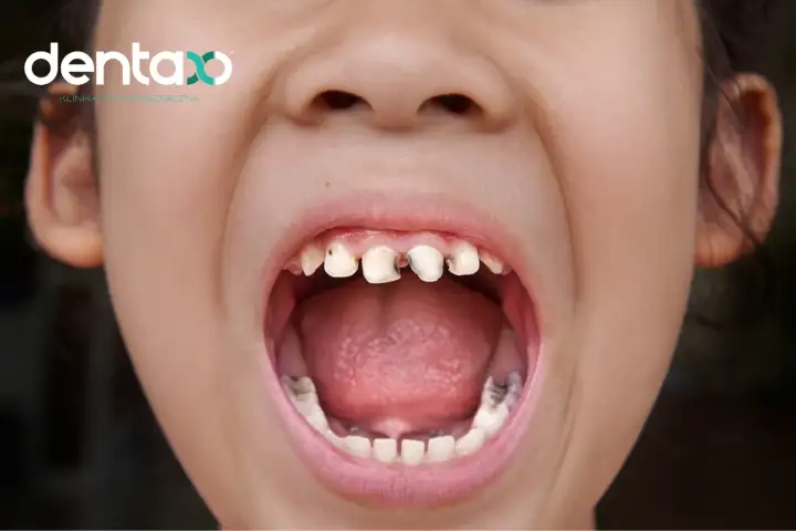 Usta dziecka z widocznymi ubytkami w zębach. Czy próchnica boli? Wizyta u dentysty może zapobiec cierpieniu.